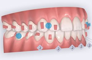 Aligners transparents : une solution discrète, flexible et technique